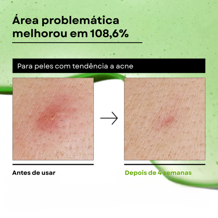 Sérum Calmante com Ácido Azelaico 10 e Ácido Hialurônico