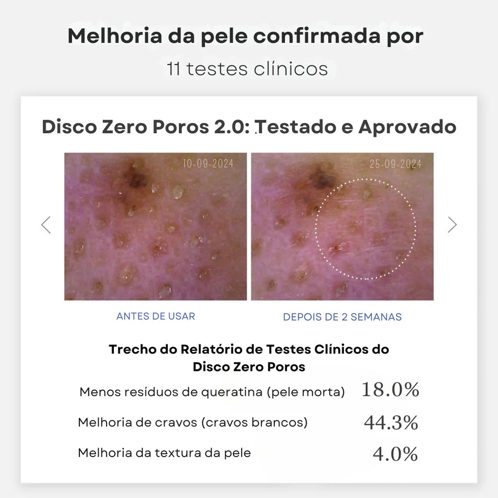 Disco Zero Poro 20 PAGUE 1 LEVE 2